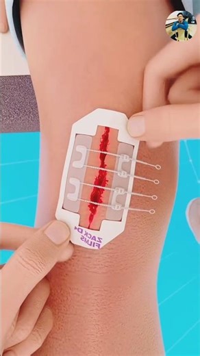 Zip Stitches 🪡 😱| No Needle, No Pain #shorts #stitch