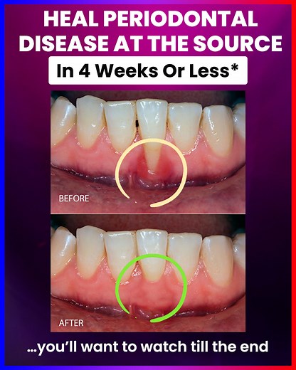The Novoral Care Pro® uses NASA-pioneered red and blue light therapy to treat gum disease at the root cause. ✔ Red light heals damaged gum tissue ✔ Blue light kills disease-causing bacteria It's backed by 3,000 clinical studies, trusted by dental professionals, and loved by thousands of users for avoiding painful, expensive surgery. Get yours today for 25% OFF (sale ends September 2nd) 👉 https://novaalab.com/products/novaa-oral-care-gums-periodontal-treatment | NovaaLab.com - The Light Therapy 