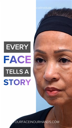 Grandma of 12. Bodybuilder. 60. And glowing. Filler from another office had left her under-eyes looking puffy. Now in her 60s, she wanted a non-surgical approach to treat her under-eyes and refresh her appearance that didn’t require long recovery time. Our signature i360 Full Face treatment did exactly that by using fillers to remove dark circles and bags, and by: ▪️Softening nasolabial folds and creases around the mouth ▪️Refining and shaping her chin and jawline for natural definition ▪️Using 