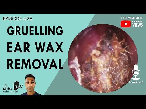 628 - Gruelling Ear Wax Removal