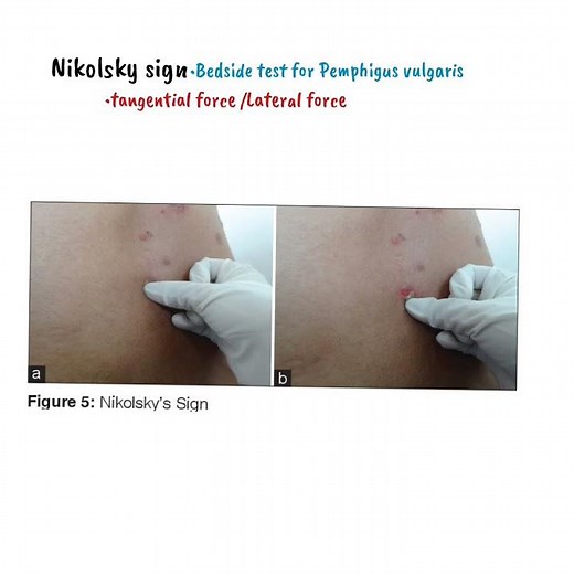 Nikolsky's sign | Pemphigus vulgaris | Dermatology