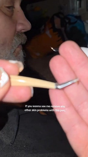 I didn’t realise how much that little spot on my neck was stressing me out… until it started fading away after one quick session with this pen. It dried up faster than I expected and the area healed smoother than anything I’ve tried before. I genuinely feel more confident wearing my hair up now. If you’re curious how it works, I left the link below | Nolanis