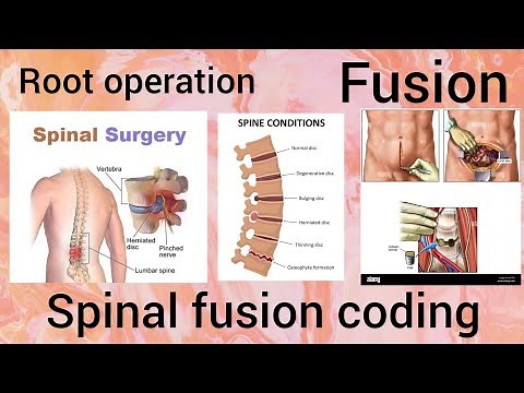 ICD 10 PCS coding Root operation: Fusion-Spinal fusion coding