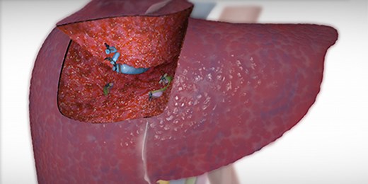 Segment IVa/VIII liver resection - TVASurg - The Toronto Video Atlas of Surgery