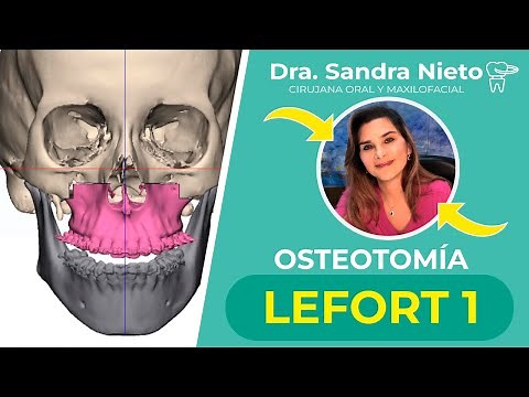OSTEOTOMÍA LEFORT TIPO 1