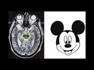 Signs seen in PSP + Mickey Mouse sign in Radiology