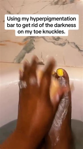 17K views · 55 reactions | Dark toe knuckles? Not this summer ✨ I’m using our Hyperpigmentation Bar inside the Exfoliating Soap Bag for a deeper scrub & faster results 禮 Smooth, even-toned skin from head to toe is just a wash away! Comment ‘BAR’ below & we’ll DM you the link! #RichAndClear | Rich & Clear Skincare | Facebook