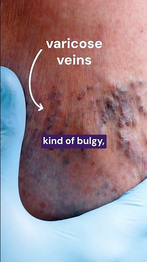 Spider and vein treatment options in the news