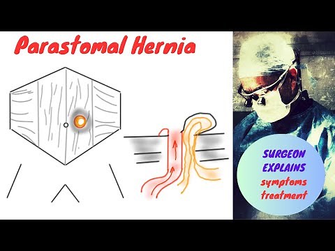 Parastomal Hernia Symptoms and Treatment