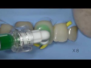 Icon tache blanche superficielle