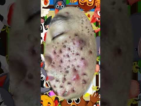 Blackheads Removal #612 | Acne Treatment and Very Satisfying Satisfying Pimple pop #blackheads