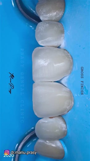 Minimally Invasive Smile Transformation!✨✨✨