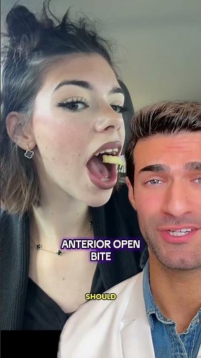 Anterior Open Bite - Here is what you need to know!? #shorts #dentist #openbite