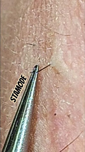 Stubborn Hair — Hard Pull Release 😬