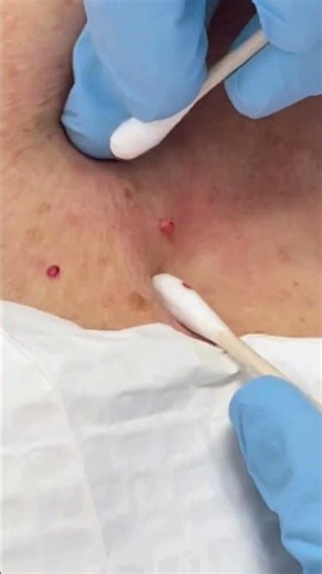 Extraction Satisfaction | Simply Dermatology | Dr Kally Papantoniou