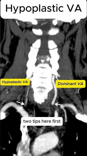 Hypoplastic Vertebral Artery: a common anatomic variant.