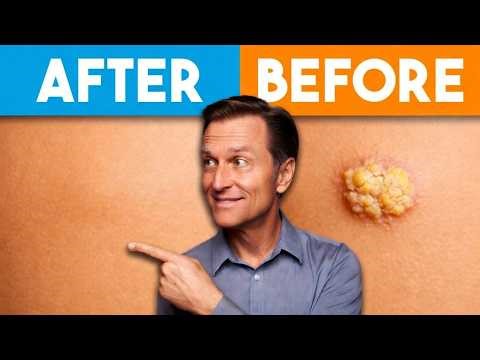 How To Remove Skin Tags And Warts Overnight | Dr Berg