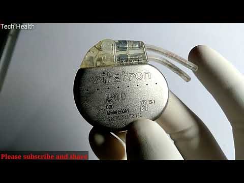 Pace Maker Implantation during complete heart block|| PPI vs TPI || how Pacemakers work,what is pace