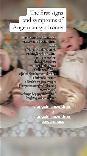 The signs and symptoms of Angelman Syndrome