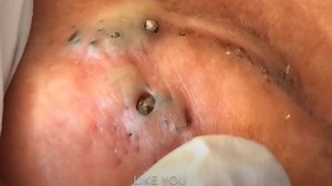 Nasty EAR Blackheads Revealed