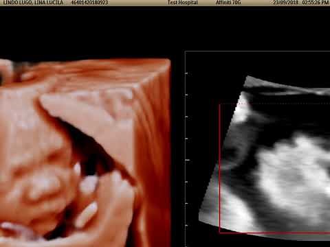 Fetal Heart Navigator (FHN). Epiq 5G. Philips.