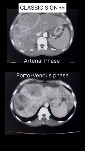 HCC Triple Phase CT | Arterial Washout #shorts