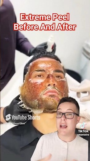 (tw) SHOCKING CHEMICAL PEEL - Phenol Peel Results #shorts