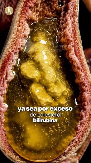 Así se forman los cálculos ⚠️