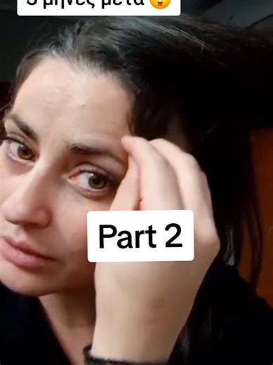 Αυτα ειναι τα αποτελεσματα της @iwanna parma🦋 πριν καν ολοκληρωθει η θεραπεια. Σοοοκκ Στειλε εαν ταλαιπωρησε κ εσυ με τριχοπτωση