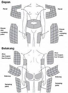 Cara Injeksi Insulin dan Tempatnya