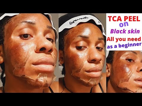 TCA peel beginner's guide/applying 15% TCA peel at home
