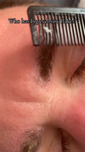 8K views · 317 reactions | Who knew dandruff could hide in your eyebrows too? ‍♀️ Watch those flakes disappear, so satisfying! #EyebrowDandruff #FlakyBrows #SatisfyingVideo #ScalpCare #SkincareRoutine #ViralReel #BeforeAndAfter #DandruffTreatment #SelfCareJourney #GlobalTrend #SkincareTikTok #BeautyRoutine #FlakesBeGone #CleanSkinGoals #ViralVideo2025 #ASMRBeauty #TransformationVideo #SatisfyingClean #BeautyTok #EyebrowCare | Kelvin Watson | Facebook