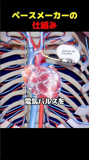 How a pacemaker works