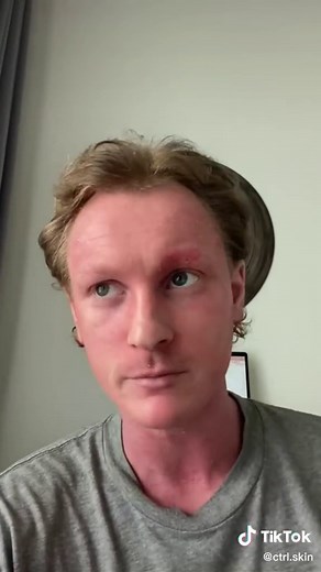 How to Start TSW: First Signs & Treatment Guide