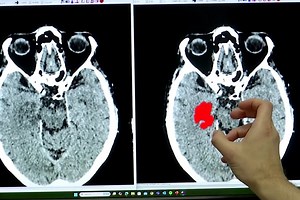 New AI software doubles stroke diagnosis accuracy | ABS-CBN News