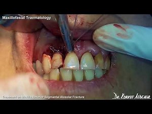 Maxillofacial Travmatology - Treatment On Maxilla Anterior Segmental Aveolar Fracture