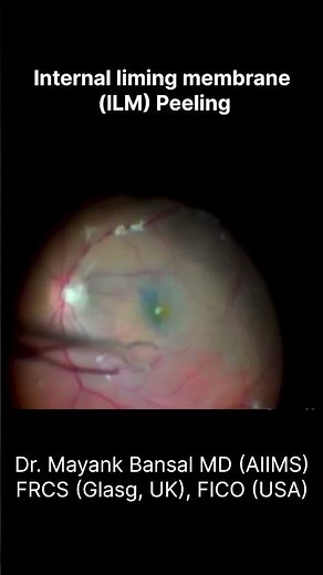 ILM Peeling: Essential for Macular Hole Repair & Vision Restoration #retinaldetachment #macularhole