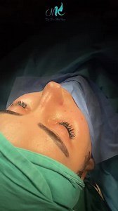 A patient came to us with a crooked nasal tip, uneven nostrils, and subtle cartilage irregularities that disrupted her facial symmetry.