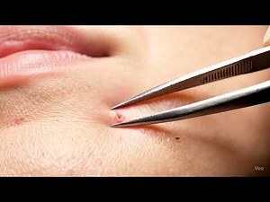 Satisfying INGROWN Hair Removal on Woman's Face! Close-Up View! | #IngrownHair