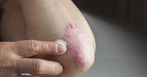"J'ai guéri du psoriasis" : une dermatologue partage ses conseils pour mieux le vivre au quotidien