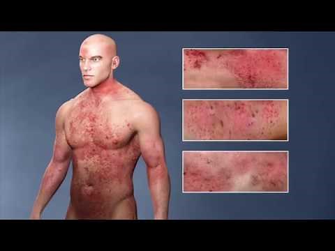 Atopic Dermatitis, (eczema); From the Inside Out