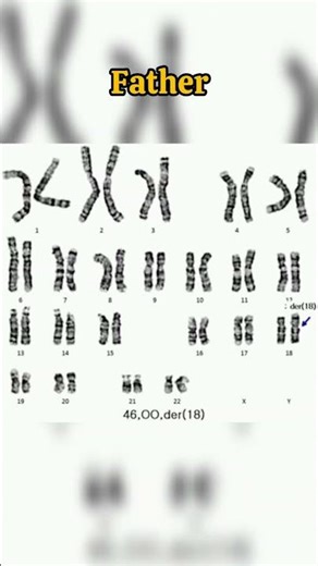 🔬Abnormal Karyotype | Part 10 #biology #shorts #genetics