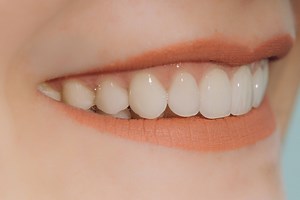 Tooth Wear Treatment Albury - Kreativ Dental Albury