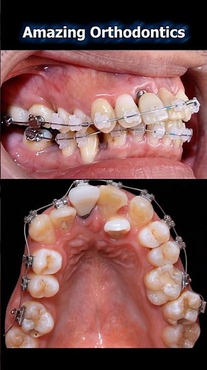 Amazing braces: Fix super crooked and bad teeth. 36 months duration #braces #orthodontics #dentist
