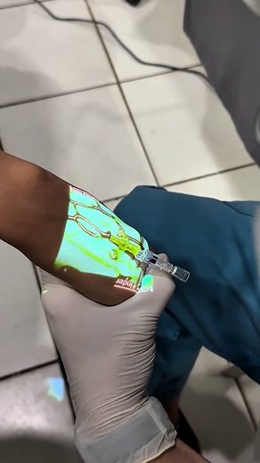 Innovative Vein Finder-Assisted IV Cannulation Techniques