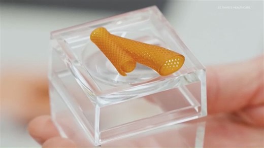 Clinical trial testing device that could help chronic kidney disease patients during dialysis | Haystack News