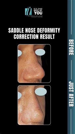 Saddle Nose Deformity Correction Before & After | Performed by Dr. P.K. Talwar Best plastic Surgeon