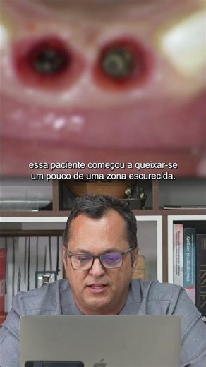 Enxerto de Tecido Conjuntivo para Aumento de Volume Peri-implantar em Zona Estética (ImplantePerio).