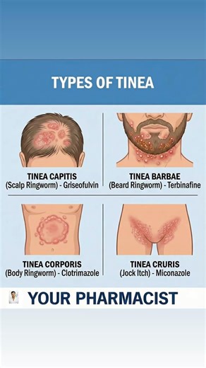 TINEA / FUNGAL INFECTION / #fungustreatment