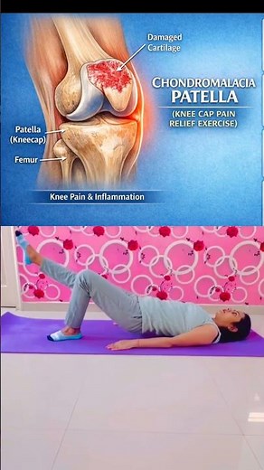 5 Best Knee-Friendly Exercises for Chondromalacia Patella or Runner's Knee Relief #kneecappain